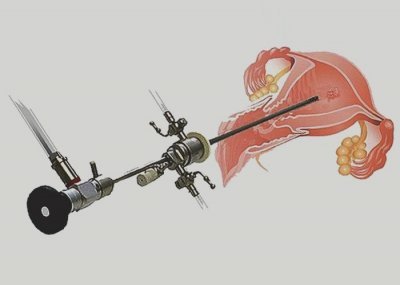 Histeroskopiya nədir?